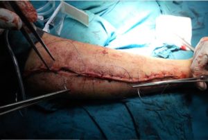 not considering the surgeon's experience